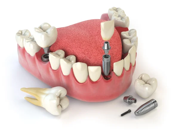E-max Veneers in Istanbul: Complete Guide for International Patients (2026)