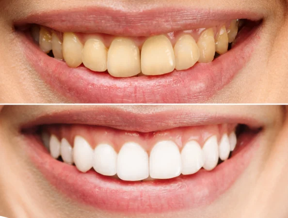 Zirconium Crowns in Istanbul: Complete Guide for International Patients (2026)