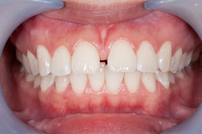 Tooth Gap (Diastema): Causes, Options and How to Close It