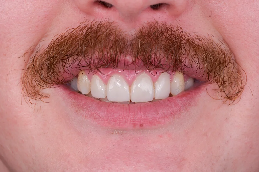 Önce Image